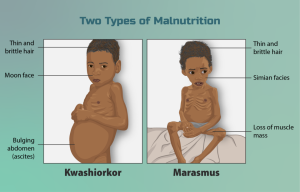 Illustration comparing two children with different forms of severe malnutrition. On the left, a child with kwashiorkor appears with a swollen belly, thin and brittle hair, and moon face. On the right, a child with marasmus is extremely thin with visible ribs and loss of muscle mass, thin and brittle hair, and simian face. Both children have sad expressions and are depicted with minimal clothing to emphasize physical symptoms.