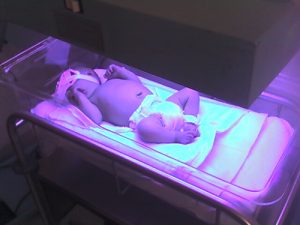 Jaundiced baby under UV light